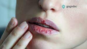 chapped lips causes symptoms and