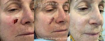 mohs surgery before after photos laser ny