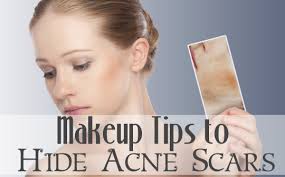 acne scars