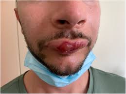 lip angioedema after indirect contact