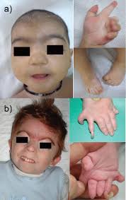 Epidemiology poland syndrome is usually sporadic, although rare familial cases. Depressed Nasal Bridge In Pediatric Orthopaedic Practice A Review