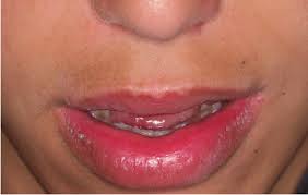 persistent lip swelling