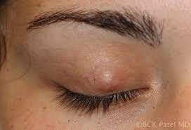 moran core what is a chalazion and
