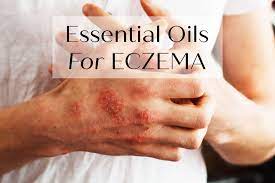 essential oils for eczema recipes and