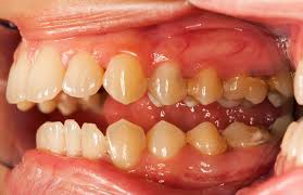 dentist tips to control tartar buildup