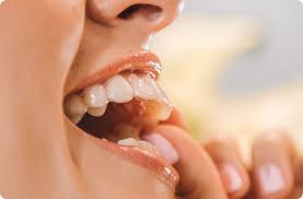 Para garantir os resultados, é preciso usar a contenção ortodôntica. Aparelho De Contencao Apos Alinhar Os Dentes Smilink