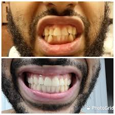 Cardi b is known for her no nonsense rapping style. Officially Just Finished Up Invisalign In 8 9 Months November 2019 August 2020 Invisalign
