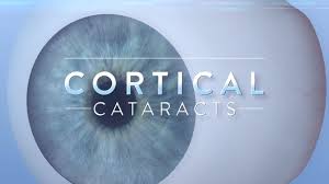 Cataracts Type Cortical Spokes