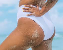 stretch marks 101 what causes them