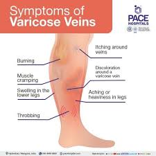 varicose veins symptoms causes