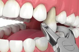 mouth after a tooth extraction
