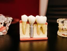 6 adverse effects of dental implants