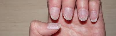 homeopathy treatment for brittle nails