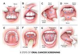 hartsland dental cancer exam