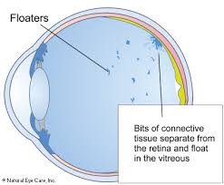 eye floater prevention symptoms news