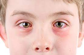 eye infections in kids signs