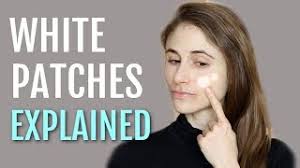 5 causes of white spots on face and how
