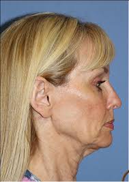 What is the recovery time healing process for a facelift? Lower Facelift What To Expect Results Cost Realself