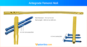 antegrade fem nail afn uses
