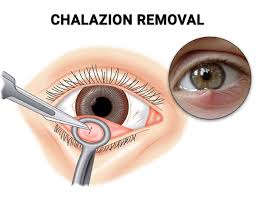 chalazion specialists in nyc vitreous