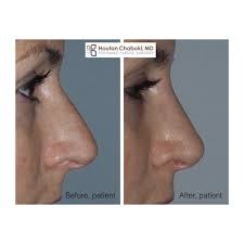 p with preservation rhinoplasty