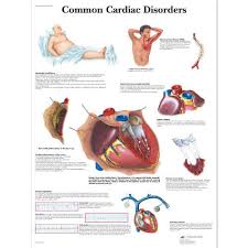Common Cardiac Disorder Posters Cardiac Disorders Anatomy