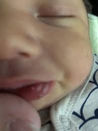 white pimple on baby s lip babycenter