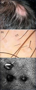 hair loss in the patient treated with