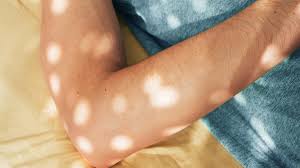 rash on elbows causes treatments and