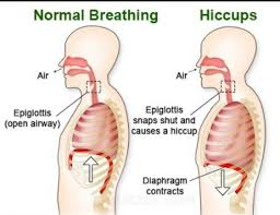PHYSIOLOGY OF HICCUPS; Hiccups,also spelled hiccough ,spasmodic and  involuntary contraction of diaphragm (the muscular partition separating  chest cavity from abdominal cavity) which causes a sudden intake of breath  that is involuntarily caused