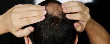 causes balding in the back of the head