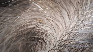 does hair dye kill lice or their eggs