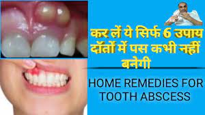 top 6 home remes for tooth abscess