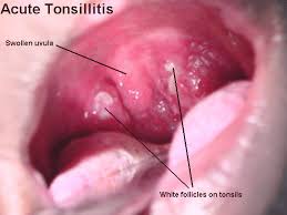 Medical Images Appearance Of Normal Tonsils And Inflamed