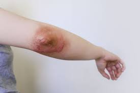 how severe eczema is treated