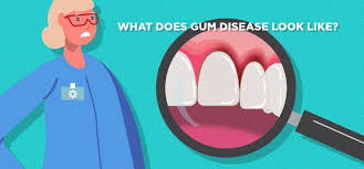 periodontal gum disease smile