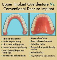implant overdentures upper shine