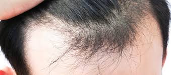 stress and hair loss cosca clinic