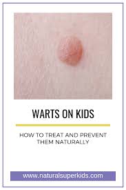 warts on kids how to treat and