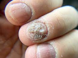 nail disorders white rock dermatology