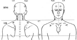 While annoying, muscle knots — also called spasms or trigger points — can often be successfully treated with home remedies, trigger point release, stretching, strengthening and using good body mechanics. Location Of Trigger Points In The Head Neck Shoulder And Upper Back Download Scientific Diagram