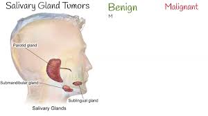 salivary gland tumors salivary gland