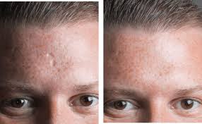 mederma for acne scars facts vs