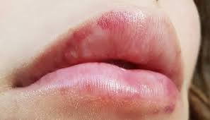lip fillers white small blister