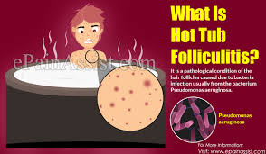 It can ease menopausal hot flashes. What Is Hot Tub Folliculitis Causes Symptoms Treatment Complications Prevention Diagnosis
