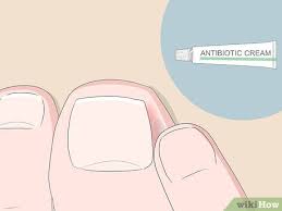 5 ways to relieve ingrown toe nail pain