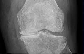the knee resource osteoarthritis oa