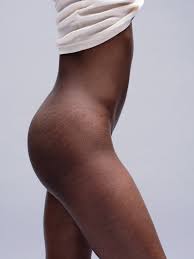 stretch marks how to minimize
