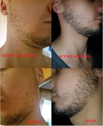 Real minoxidil testimonial for 15% minoxidil products. 2 Months Using Minoxidil Before And After Minoxbeards