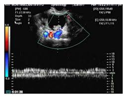 An ovarian cancer ultrasound is one of several diagnostic tests that your doctor will use to determine if ovarian cancer is present. Early Detection Of Ovarian Cancer With Conventional And Contrast Enhanced Transvaginal Sonography Recent Advances And Potential Improvements